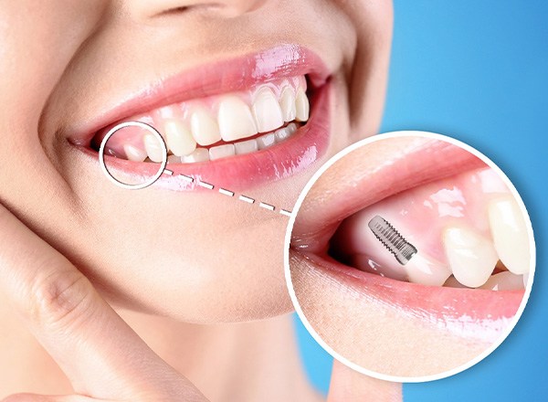 Nose-to-chin view of someone smiling touching jaw with one tooth indicated as an implant