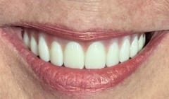 White healthy smile after treatment