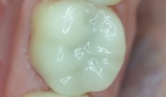 White healthy smile after treatment