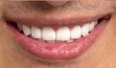 White healthy smile after treatment