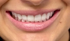 White healthy smile after treatment