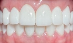 White healthy smile after treatment