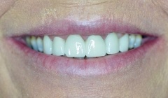 White healthy smile after treatment