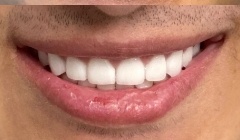 White healthy smile after treatment