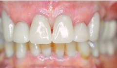 White healthy smile after treatment