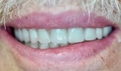 White healthy smile after treatment