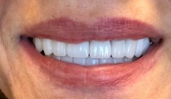 White healthy smile after treatment