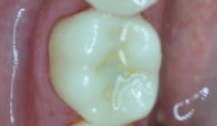 White healthy smile after treatment