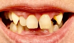 Discolored smile before treatment