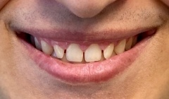 Discolored smile before treatment