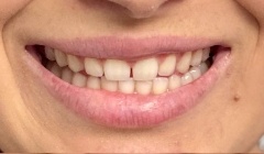 Discolored smile before treatment