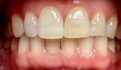 Discolored smile before treatment