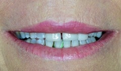 Discolored smile before treatment