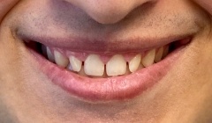 Discolored smile before treatment