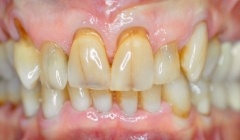 Discolored smile before treatment