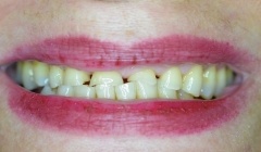 Discolored smile before treatment