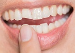 Patient pointing to chipped front tooth