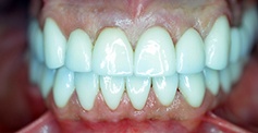 White smile after teeth whitening