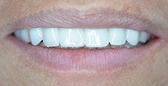 Replaced top row of teeth