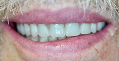 Smile after full mouth tooth replacement