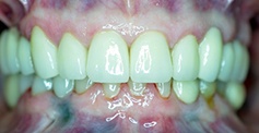 White healthy smile after treatment