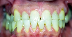 Yellow smile before teeth whitening