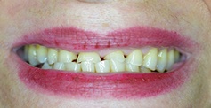 Discolored unevenly spaced teeth
