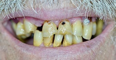 Severely decayed damaged and missing teeth