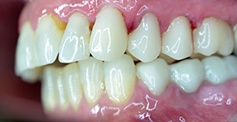 Side view of smile with discoloration at gums