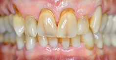 Yellowed and damaged front teeth