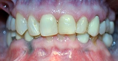 Discolored smile before treatment