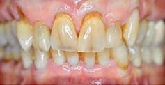 Severely decayed damaged and missing teeth