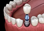 Animation of implant supported dental crown placement