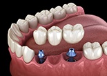 Animation of implant supported fixed bridge placement