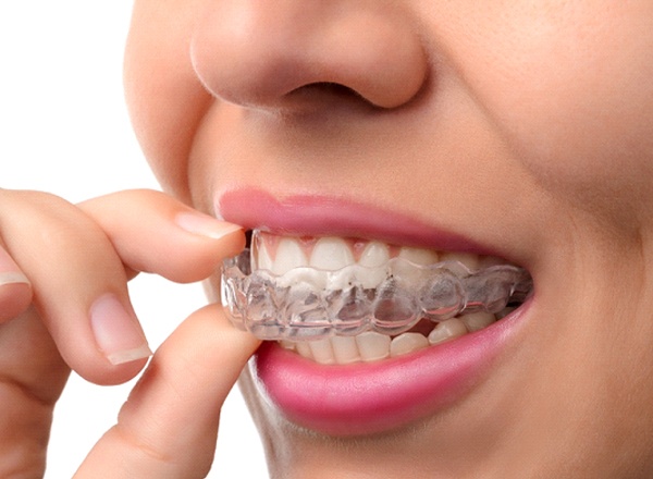 Woman taking out Invisalign in Queen Creek, AZ