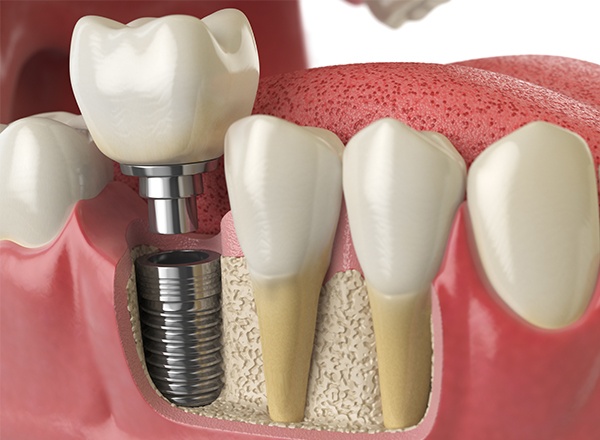 Animation of the implant supported dental crown process