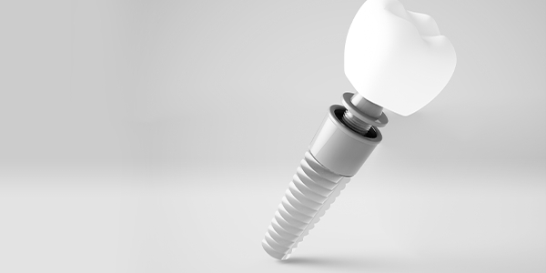 Dental implant special coupon