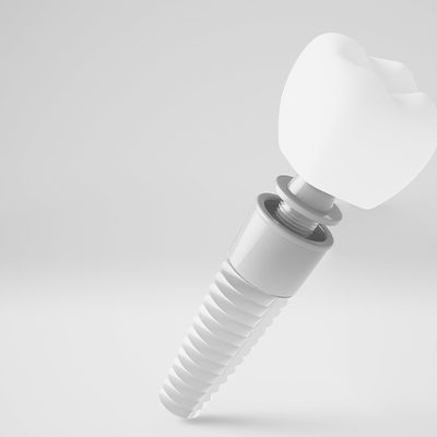 Dental implant special coupon