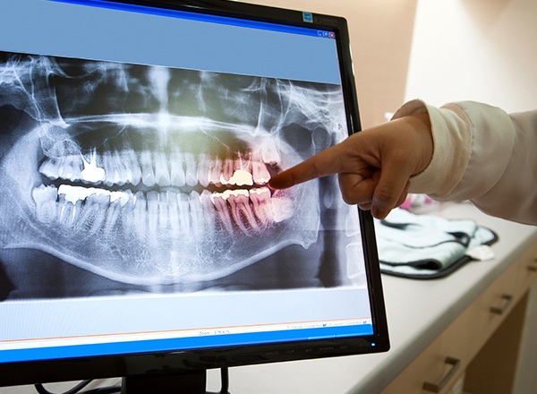 Panoramic dental x-rays