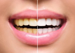 Smiling woman before and after visiting her Queen Creek cosmetic dentist