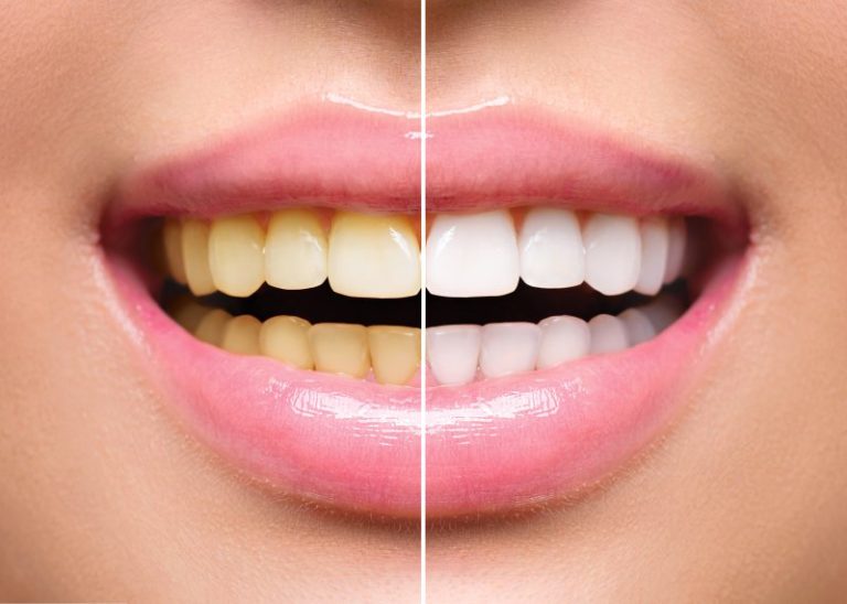how-to-fix-stained-teeth-queen-creek-queen-creek-complete-dental