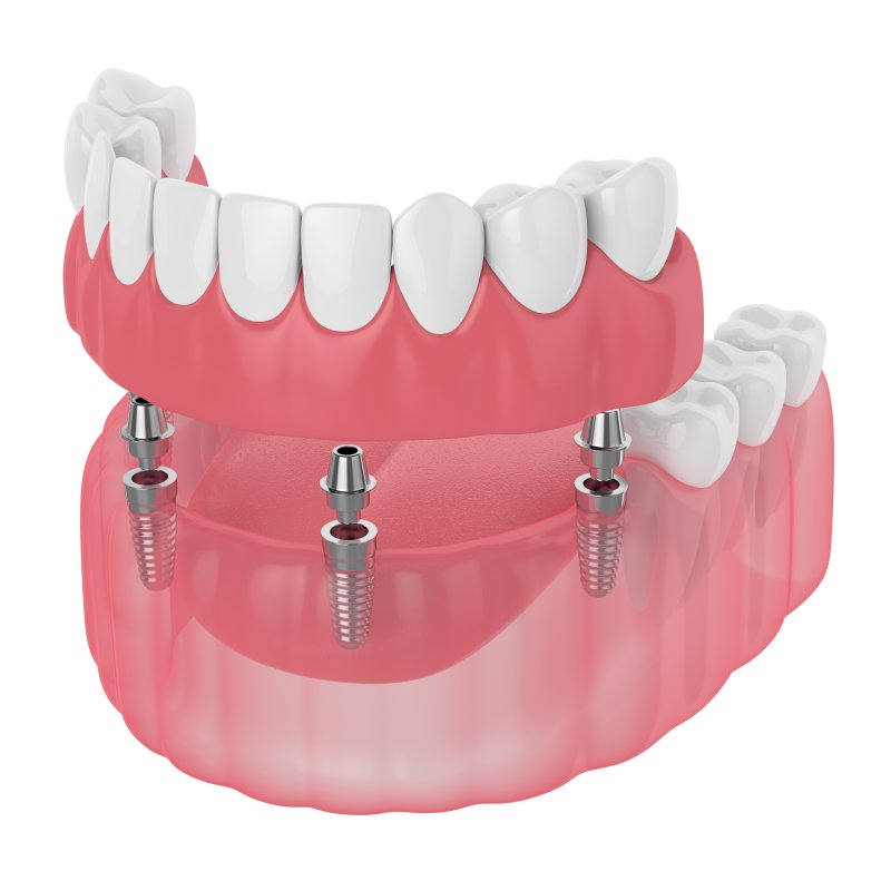 Dental implant dentures