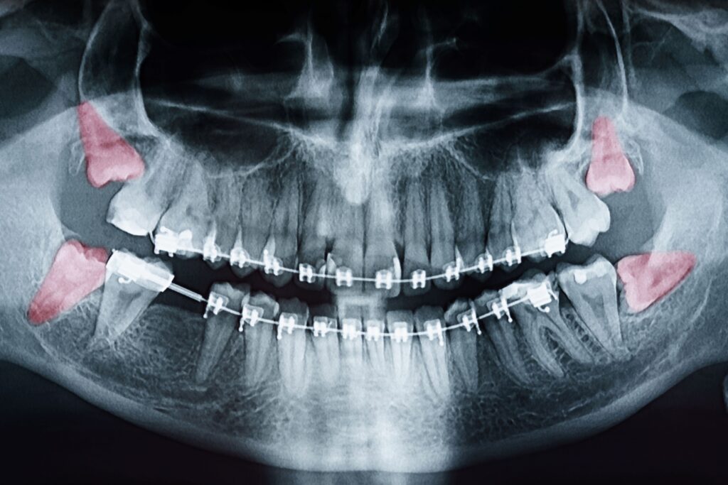 X-ray with wisdom teeth highlighted red